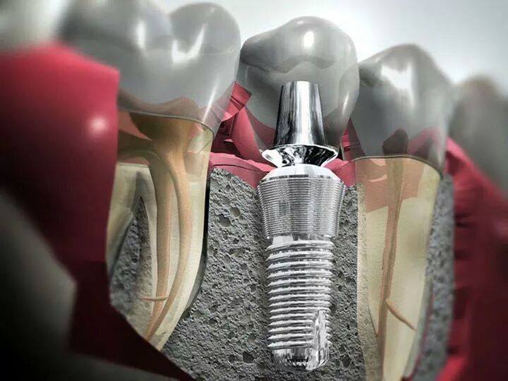 implant dentar